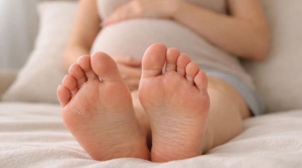 Subtle athlete's foot while pregnant, with mild peeling on feet resting on a bed