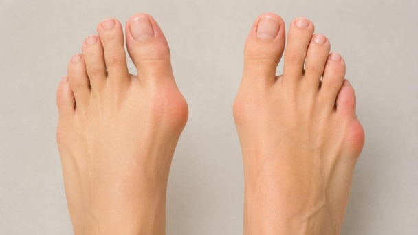 Bunions and bunionettes comparison showing big toe and little toe deformities