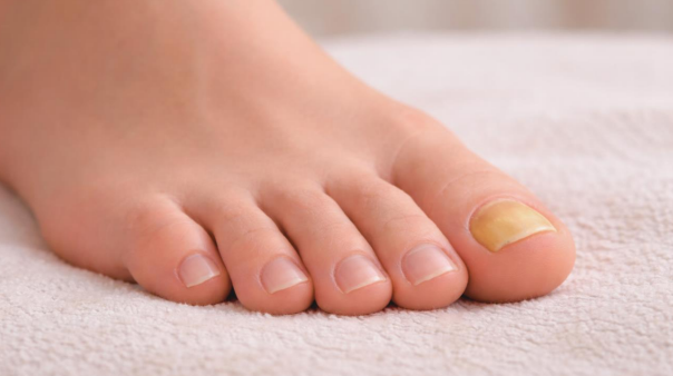 early signs of types of toenail fungus on big toenail