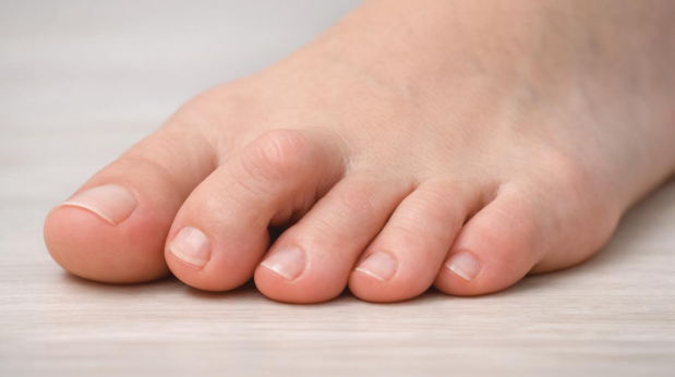 Close-up of mild hammertoe deformity showing hammertoes treatments need