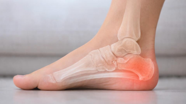 Heel spur pain shown with heel bone and plantar fascia overlay