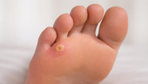 How to get rid of corns on feet showing corn on sole