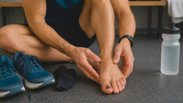 Toenail trauma in runner with bruised big toenail after sports activity