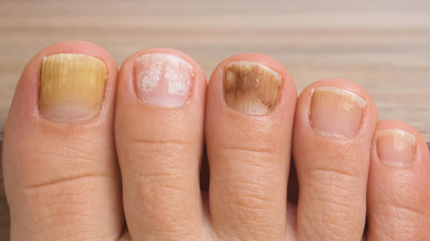 types of toenail fungus showing yellow, white, and dark nail discoloration